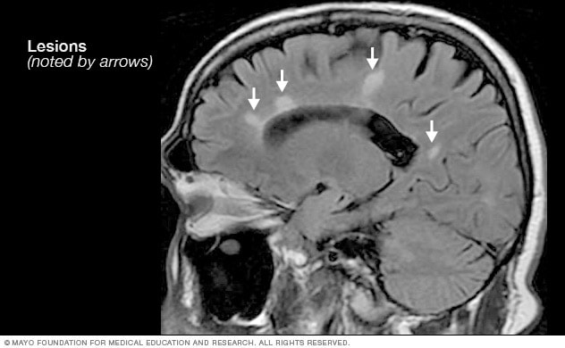 Effective Ways to Test for MS at Home: Simple Steps for 2025