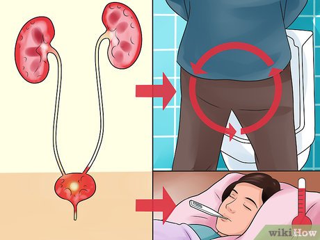 Effective Ways to Get Rid of a UTI Fast: Your Comprehensive Guide for 2025