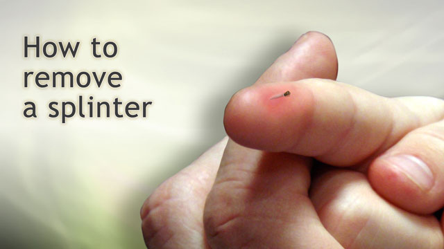 Effective Ways to Get a Splinter Out: Heal Fast and Stay Safe in 2025