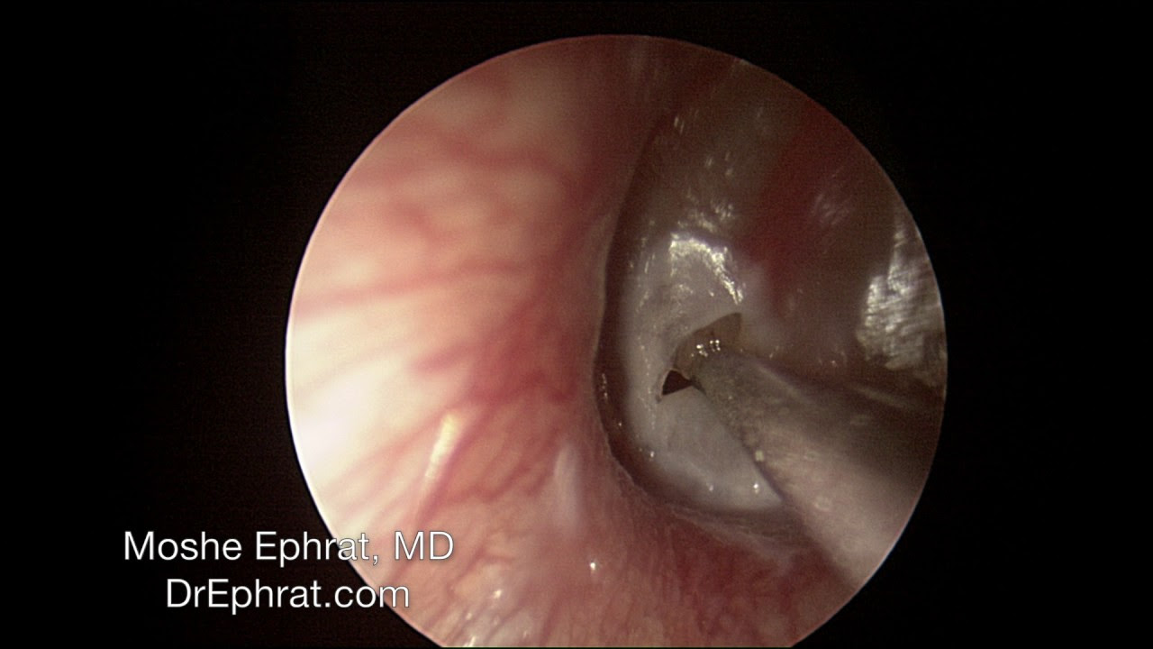 Effective Ways to Get Fluid Out of Ear in 2025 – Discover Proven Solutions!