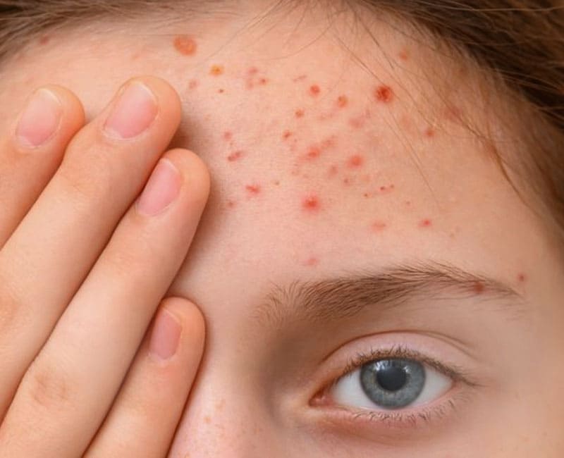 Forehead Acne Solutions