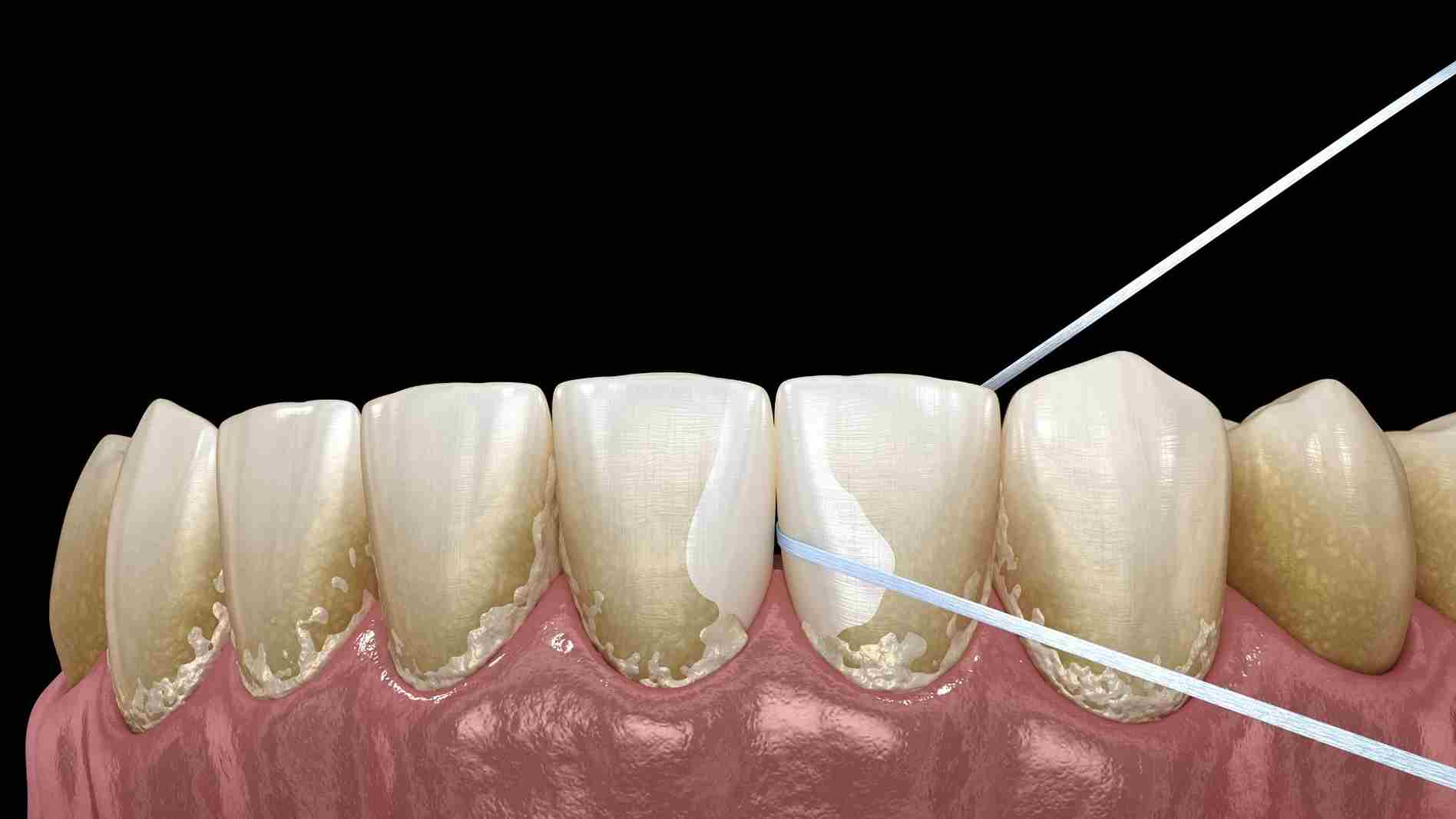 Effective Ways to Remineralize Teeth for Healthier Smile in 2025